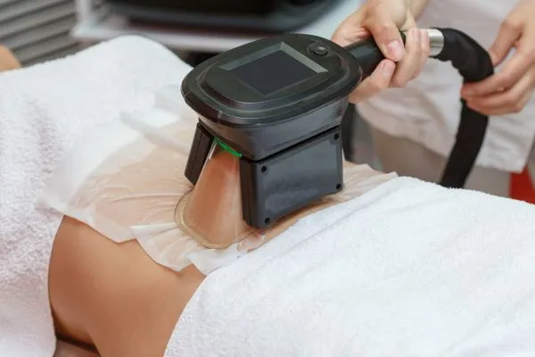 Image of person having fat freezing treatment to help weight gain Runnymede