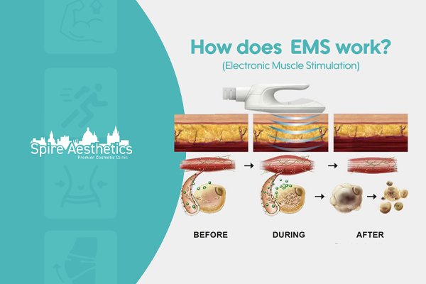 EMS treatment for post pregnancy weight loss treatment Runnymede