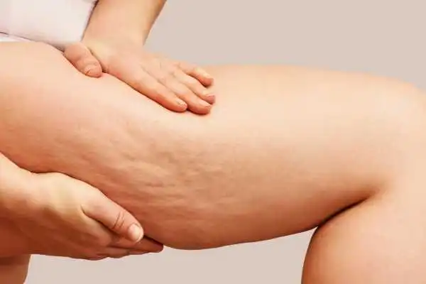Image of woman showing leg with cellulite Runnymede