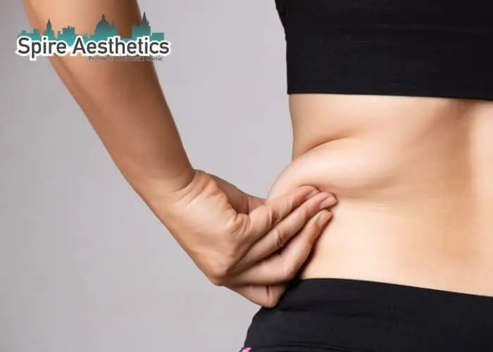 Image of woman pinching fat on their hips Runnymede. Fat Freezing treatment
