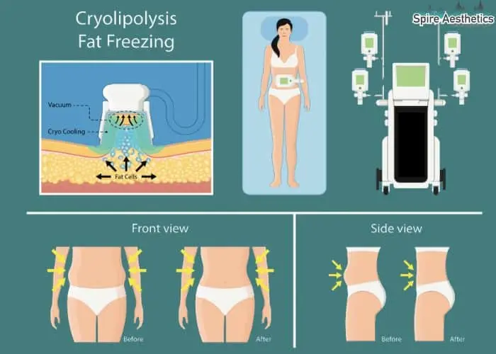 Fat freezing treatment Runnymede benefits for competitions to remove stubborn fat deposits.