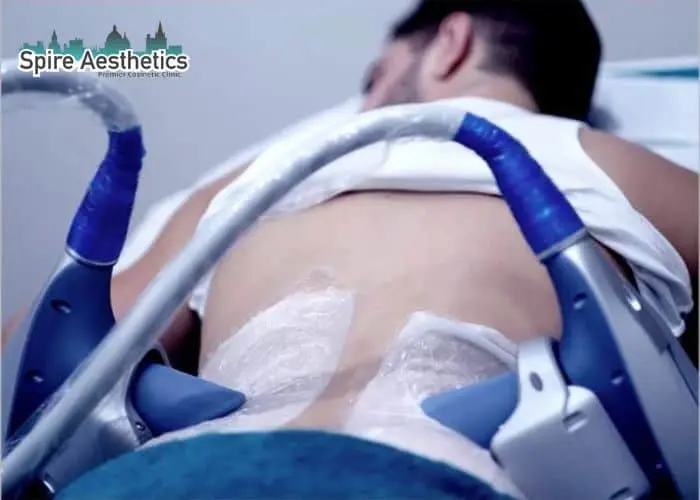 Man having fat freezing treatment done on love handles before a competitions Runnymede to create a sculpted look.