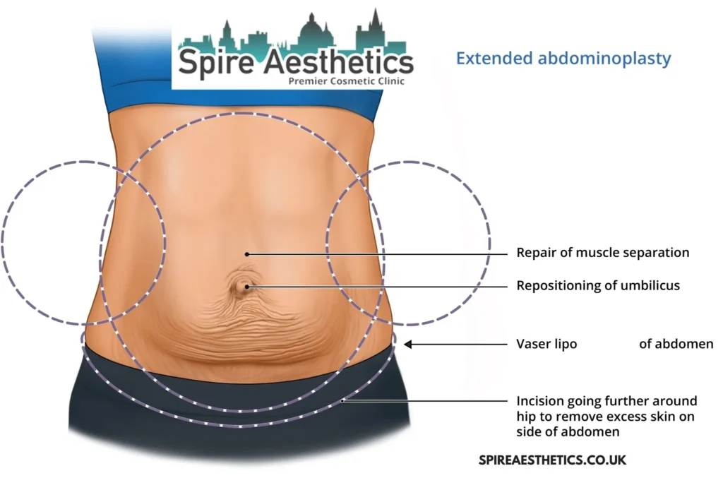 Understanding Loose Skin After Gastric Band Runnymede Surgery and HIFU Treatment 
