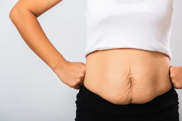 Image of a woman's stomach after weight loss with sagging skin following a gastric band Runnymede
