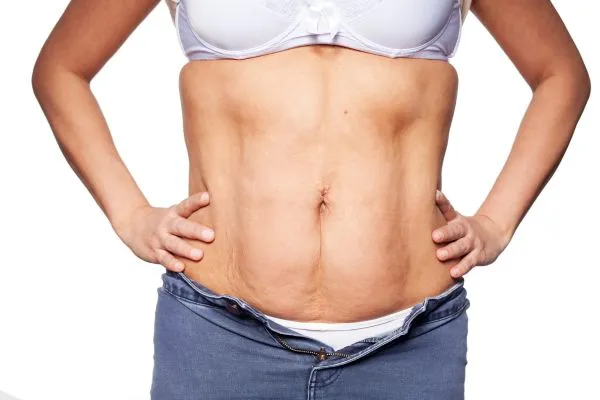 sagging skin on woman's stomach after weight loss injections Runnymede