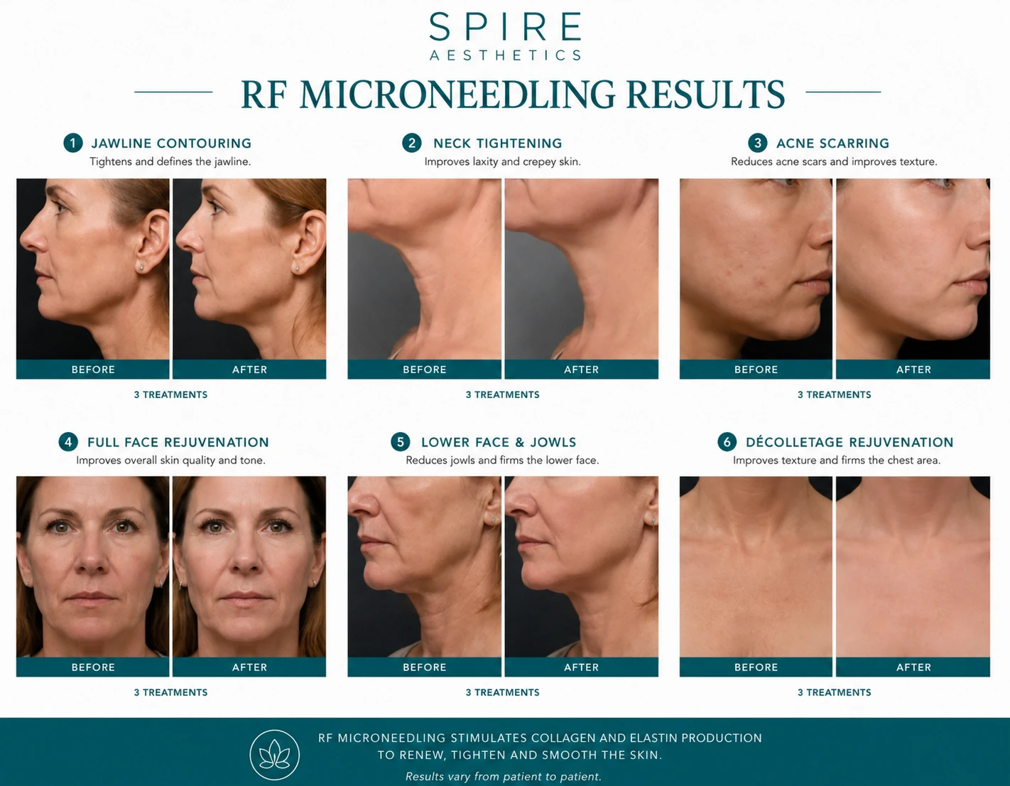 RF Microneedling Skin tightening Runnymede results