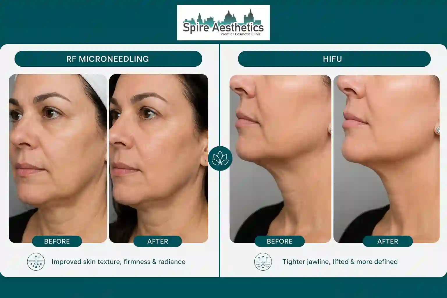 Can RF Microneedling and HIFU Be Combined Runnymede?