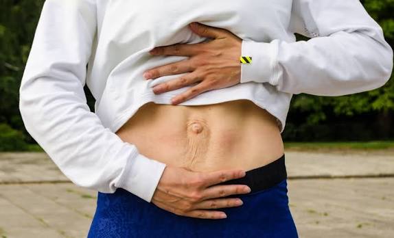 When Could Diastasis Recti Be the Missing Piece of the Puzzle Runnymede?
