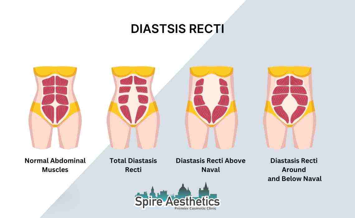 Is Non-Surgical Diastasis Recti Treatment Right for You? Common Concerns Answered Runnymede